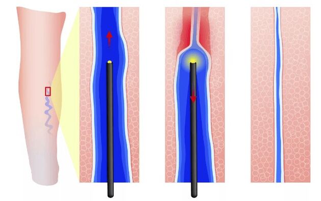 Endovasal electrokoagulation
