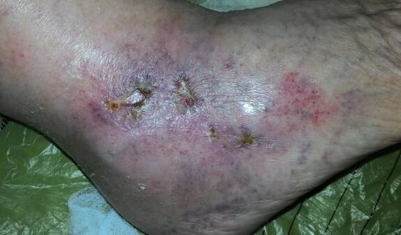 The complications of varicose veins