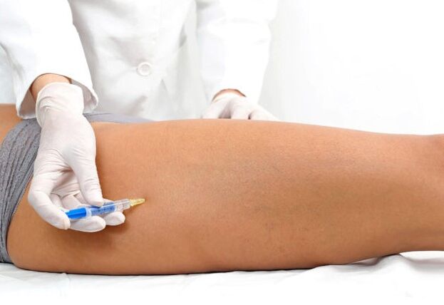 Varicose vein treatment