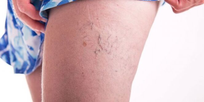 varicose veins in the feet
