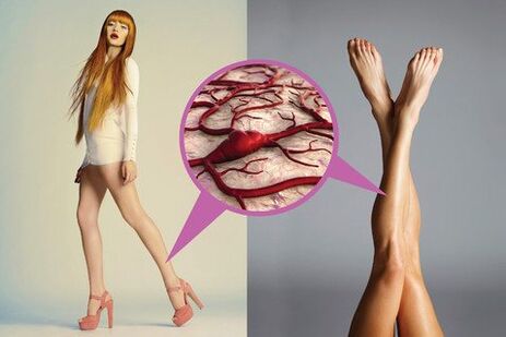 varicose veins