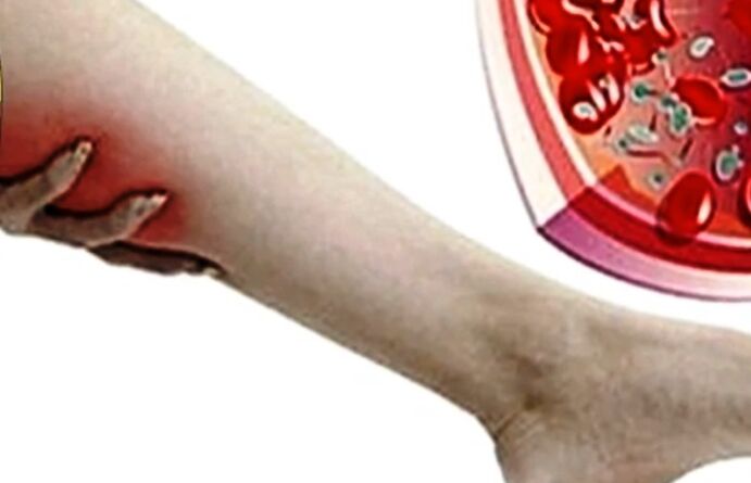 Varicose veins in the feet