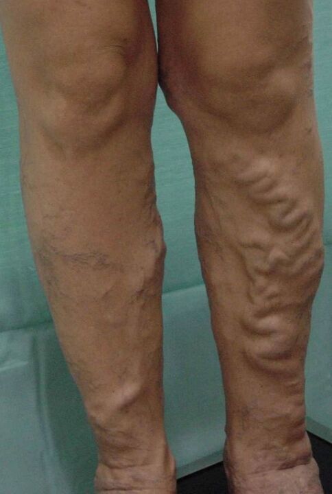 Varicose veins on the feet