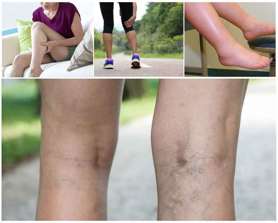 Varicosis begins