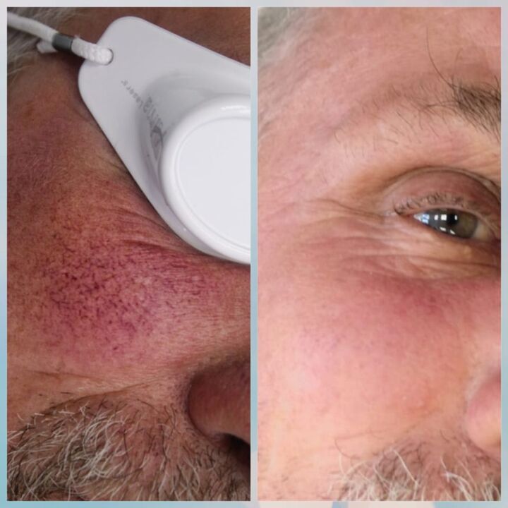 varicose veins in the face