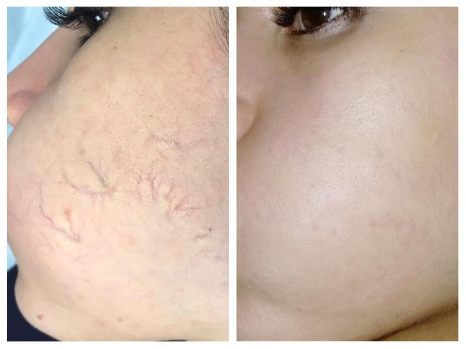 varicose veins
