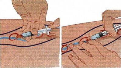 Methods for treatment of varicose veins