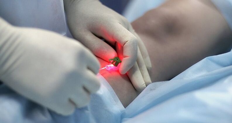 Surgical treatment of varicose veins