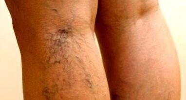 An effective way to treat varicose veins
