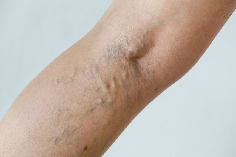 C2 stage - popliteal varicose vein (perforator Thierry) and reticular vein