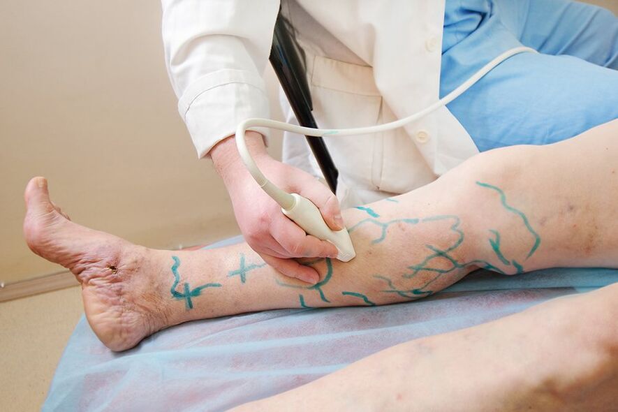 Preparation for miniphlebectomy - marking leg perforators, performing an ultrasound scan