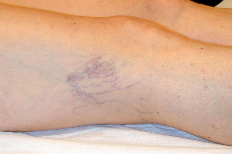 Stage C1 - reticular veins with a diameter of about 1 mm