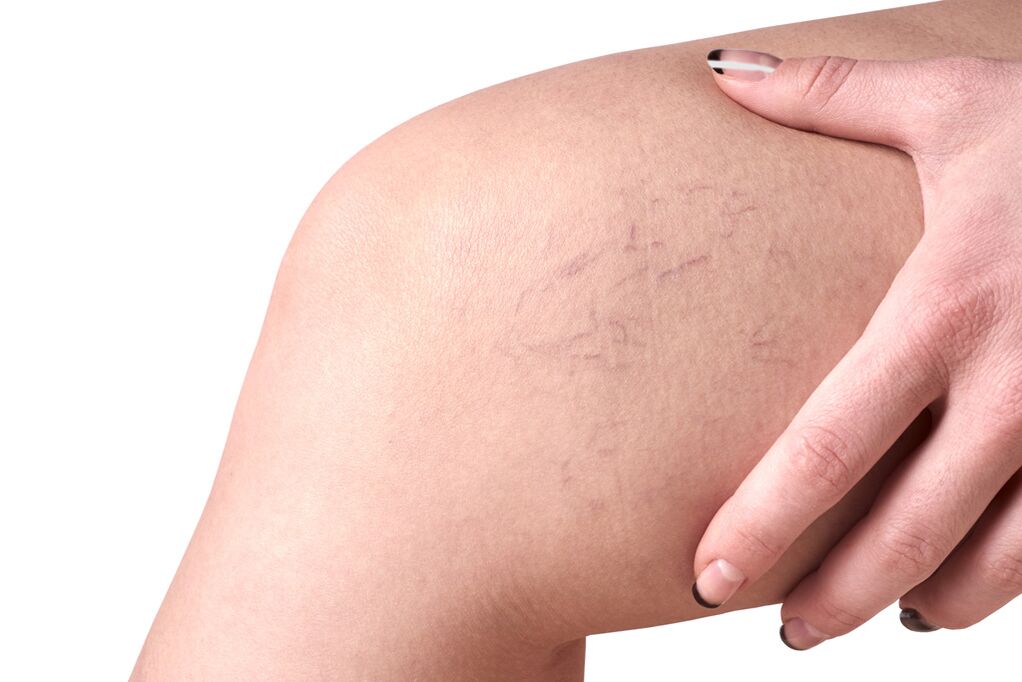 Stage C1 - spider veins