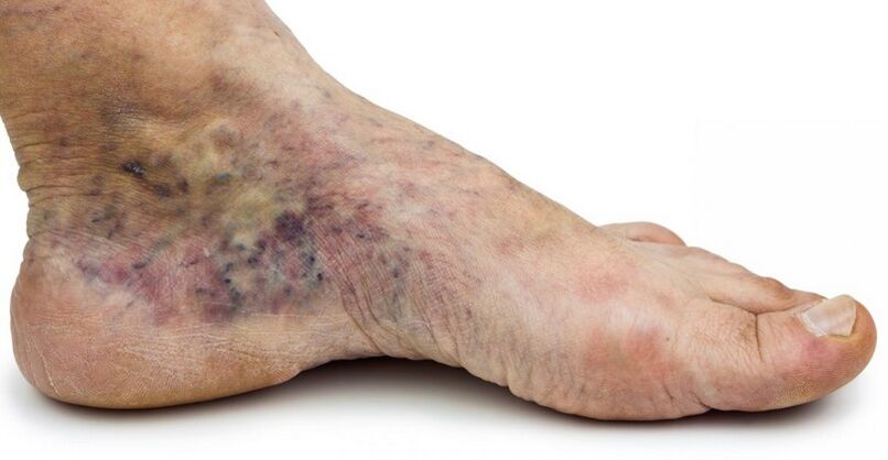 Stage C4c - crown of the foot, phlebitis in the middle