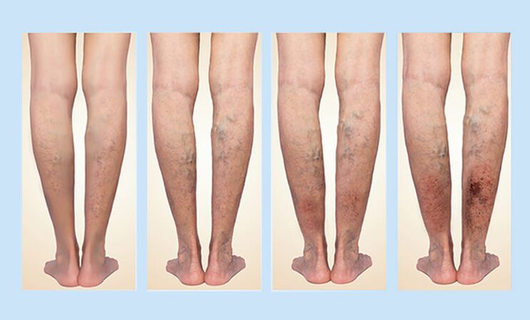 Varicose vein stage