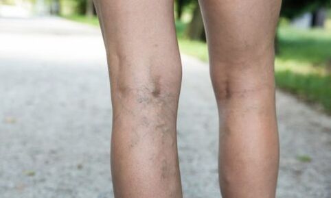 the appearance of varicose veins, symptoms of varicose veins